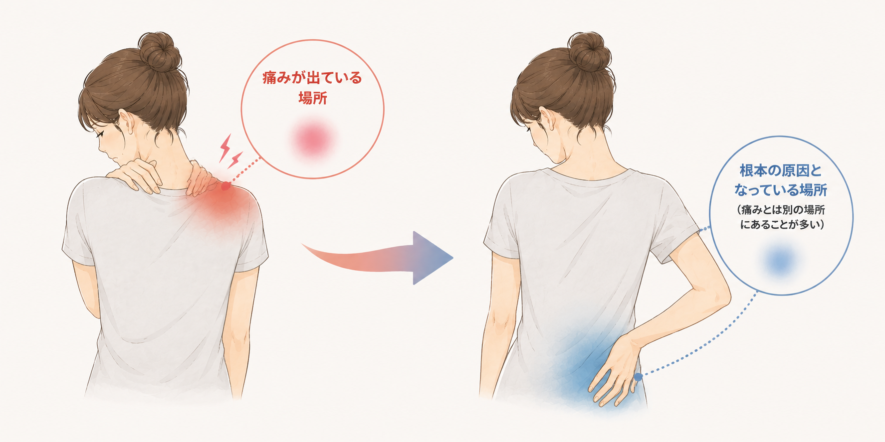 痛む場所と原因の場所が違う図解